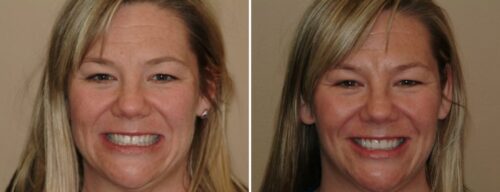 Results after dentistry at AH Smiles