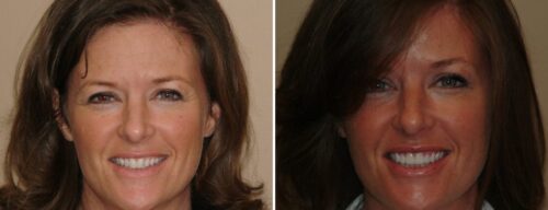 Results after dentistry at AH Smiles