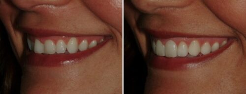 Results after dentistry at AH Smiles