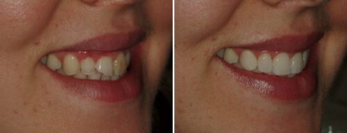 Results after dentistry at AH Smiles