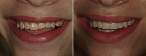 Results after dentistry at AH Smiles