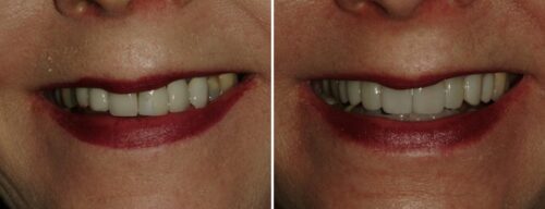 Results after dentistry at AH Smiles