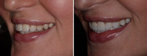 Results after dentistry at AH Smiles