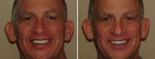 Results after dentistry at AH Smiles