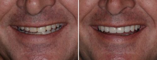 Results after dentistry at AH Smiles