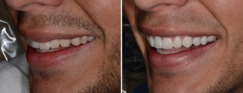 Results after dentistry at AH Smiles