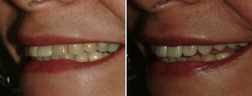 Results after dentistry at AH Smiles