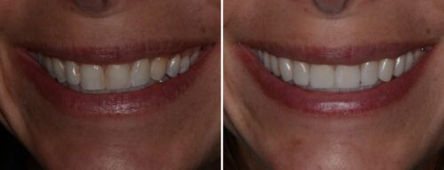 Results after dentistry at AH Smiles