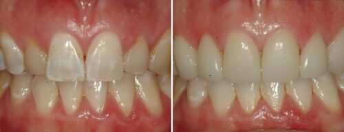 Results after dentistry at AH Smiles