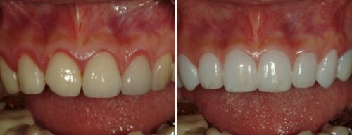 Results after dentistry at AH Smiles