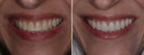 Results after dentistry at AH Smiles