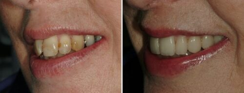 Results after dentistry at AH Smiles