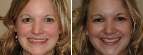 Results after dentistry at AH Smiles