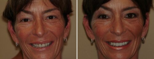 Results after dentistry at AH Smiles