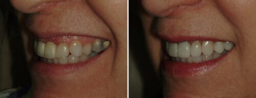 Results after dentistry at AH Smiles