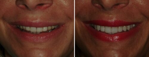 Results after dentistry at AH Smiles