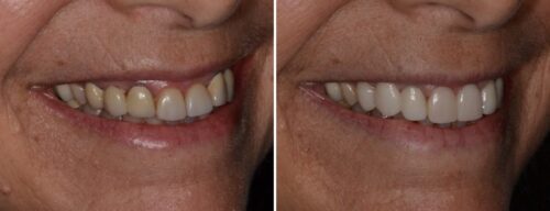 Results after dentistry at AH Smiles