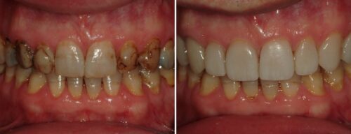 Results after dentistry at AH Smiles