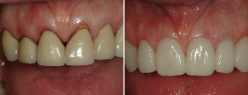 Results after dentistry at AH Smiles