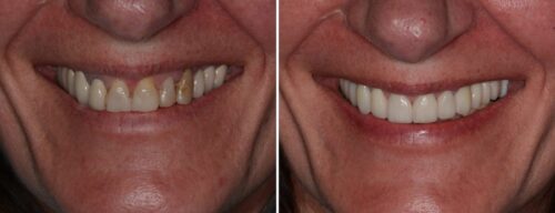 Results after dentistry at AH Smiles