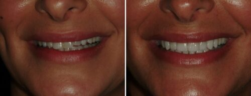 Results after dentistry at AH Smiles