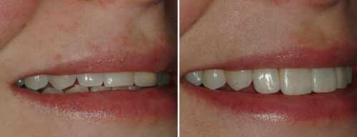 Results after dentistry at AH Smiles