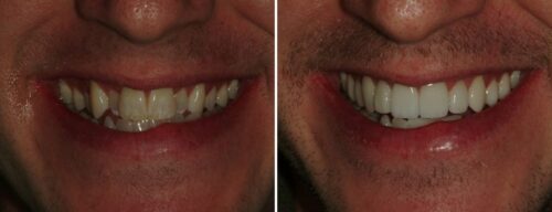 Results after dentistry at AH Smiles