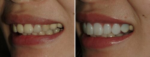 Results after dentistry at AH Smiles