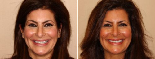 Results after dentistry at AH Smiles