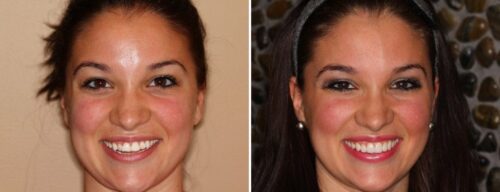 Results after dentistry at AH Smiles