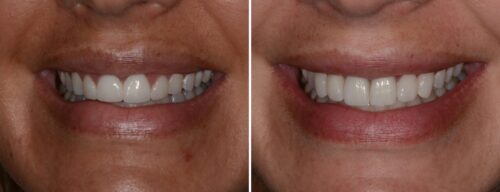 Results after dentistry at AH Smiles