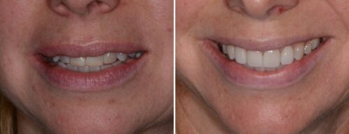 Results after dentistry at AH Smiles