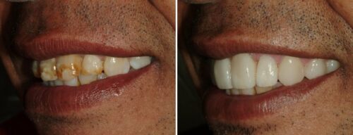 Results after dentistry at AH Smiles