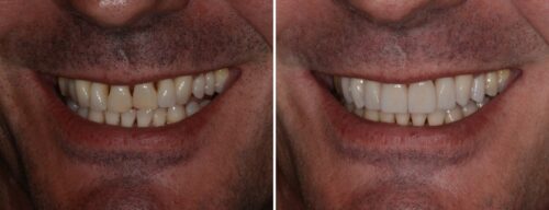 Results after dentistry at AH Smiles