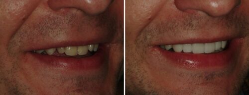 Results after dentistry at AH Smiles