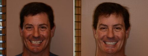 Results after dentistry at AH Smiles