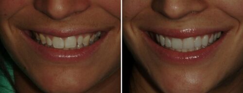 Results after dentistry at AH Smiles