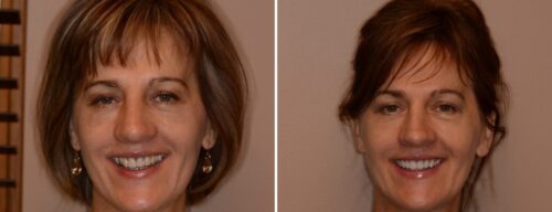 Results after dentistry at AH Smiles