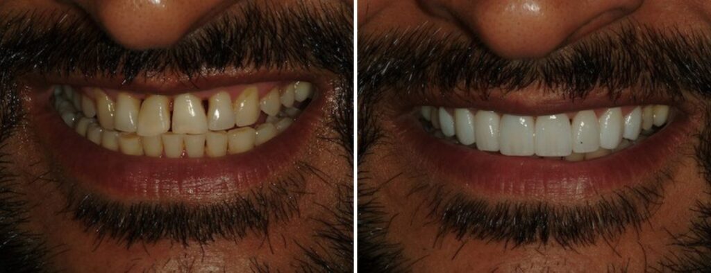 Happy AH Smiles patient before and after restorative services