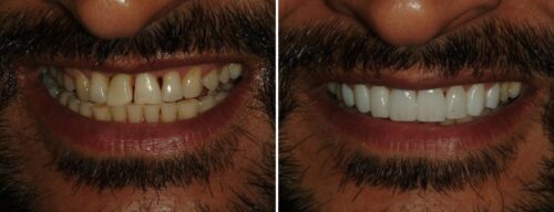 Results after dentistry at AH Smiles