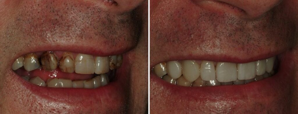 Patient before and after replacing dead teeth with dental implants