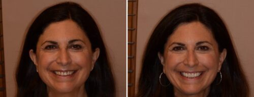 Results after dentistry at AH Smiles