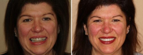 Results after dentistry at AH Smiles