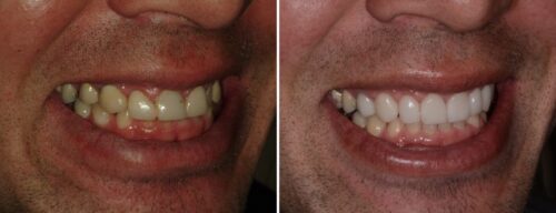 Results after dentistry at AH Smiles