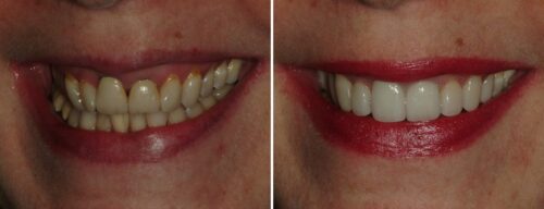 Results after dentistry at AH Smiles