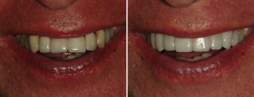 Results after dentistry at AH Smiles