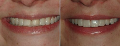 Results after dentistry at AH Smiles