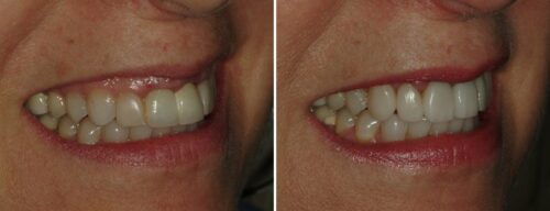 Results after dentistry at AH Smiles