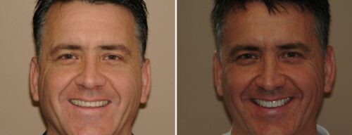 Results after dentistry at AH Smiles