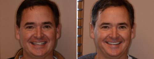 Results after dentistry at AH Smiles